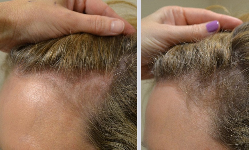 Image 4: Three PRP Tubes for Advanced Hair Restoration Treatment