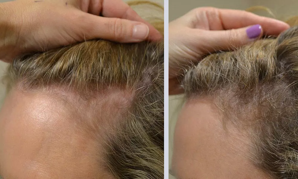Three PRP Tubes for Advanced Hair Restoration Treatment