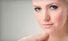 One or Three Laser Acne Treatments at Desert In Bloom (Up to 67% Off)