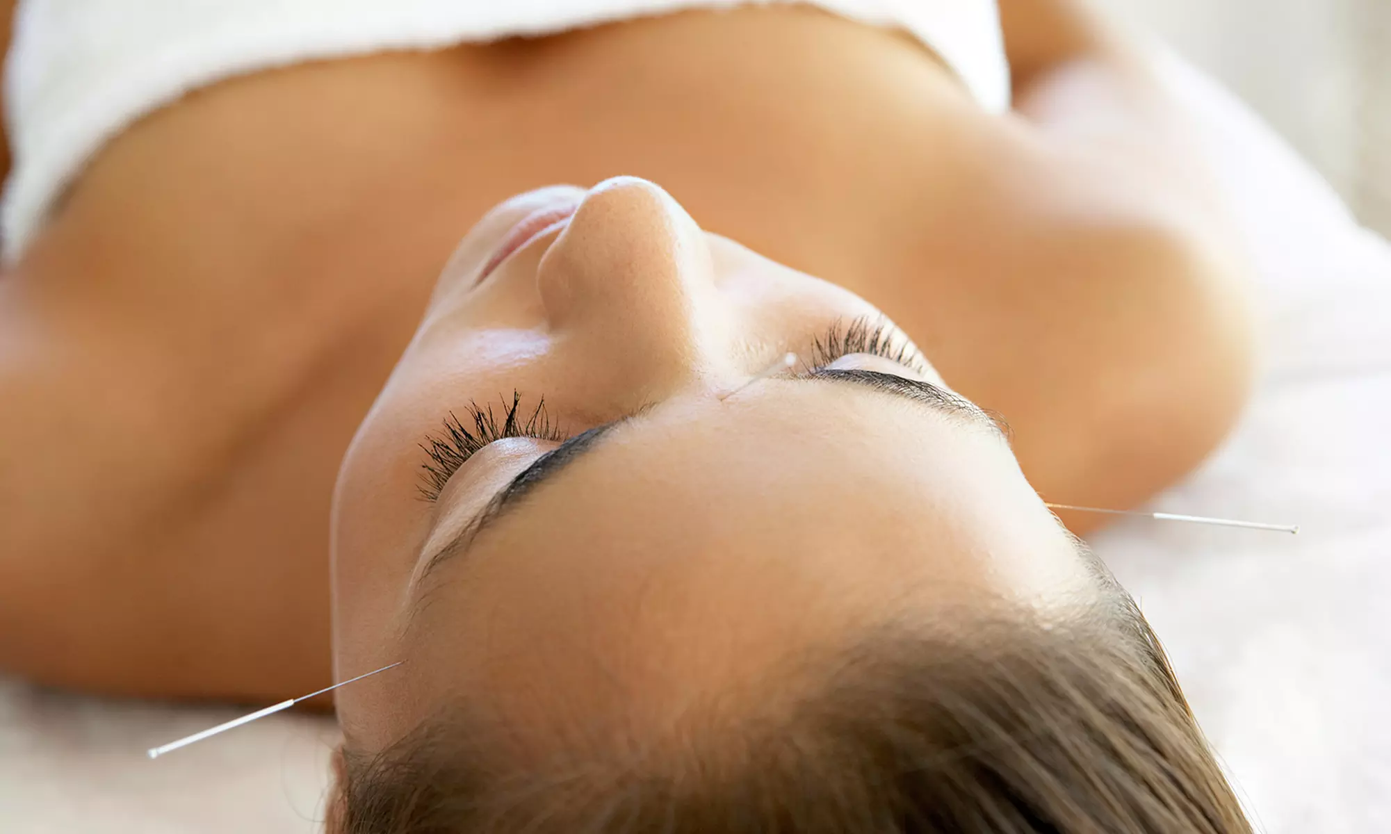 $41.50 for an Acupuncture Treatment at AcuSpa Wellness Center & Spa (Up to $145 Value) - Primary Image