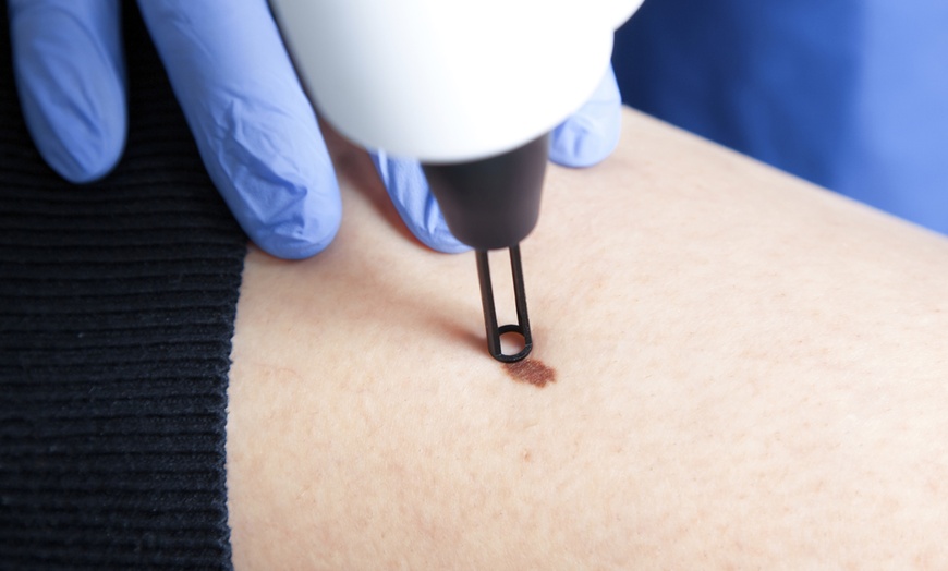 Image 1: Fix Your Blemishes with Lesion Removal – Choose 1, 3, or 10 Sessions
