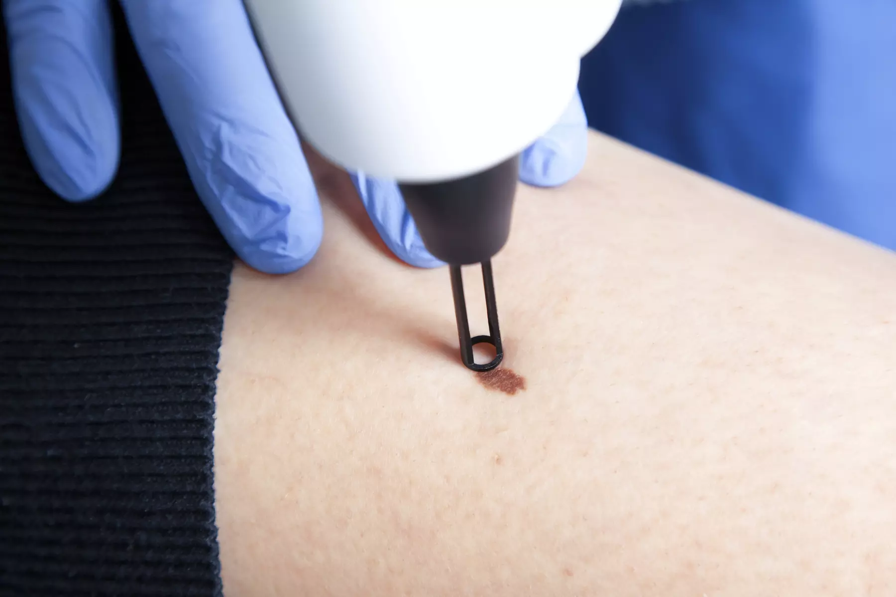 Fix Your Blemishes with Lesion Removal – Choose 1, 3, or 10 Sessions at Bioskin Beauty place (Up to 50% Off) - Primary Image