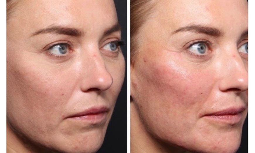 Image 7: One Session of 0.5ml,1ml or 2ml Dermal Filler With Consultation