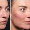 Image 7: One Session of 0.5ml,1ml or 2ml Dermal Filler With Consultation