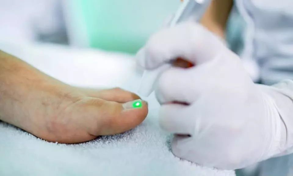 Frisse, gezonde nagels: laserbehandelingen tegen kalk/schimmelnagels