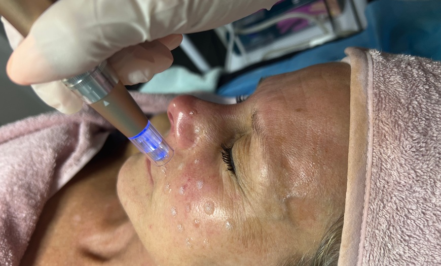 Image 4: Microneedling / Mikrodermabrasion