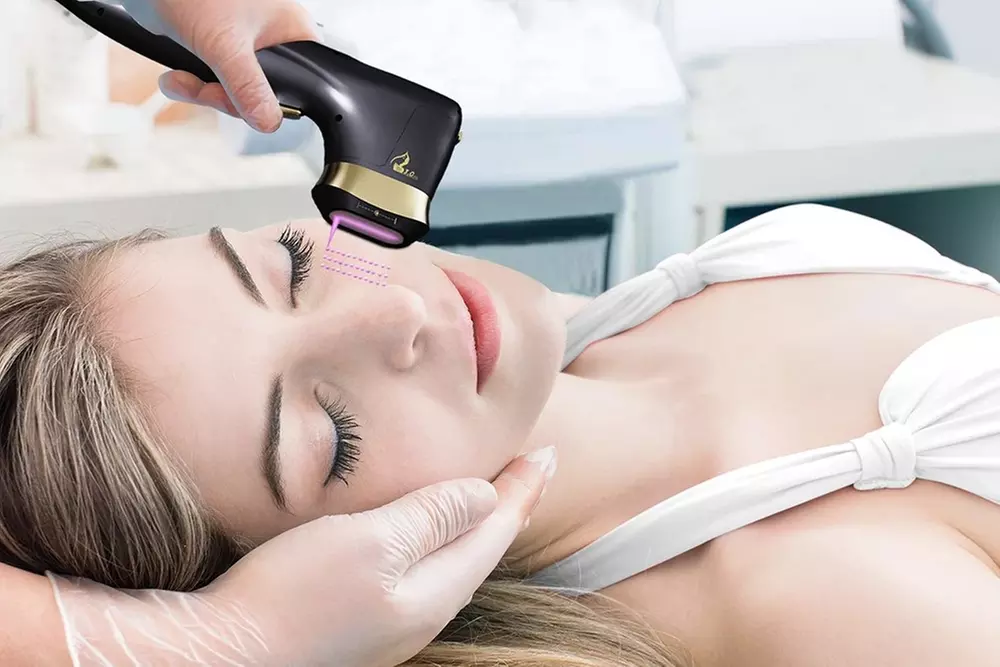 Sesión de tratamiento HIFU 22D en una zona de rostro completo