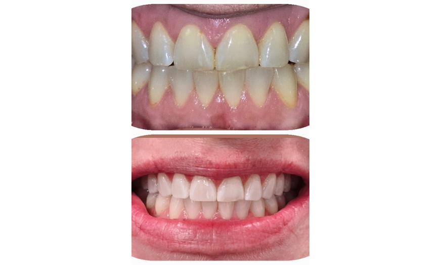 Image 2: Teeth-Whitening Treatment at Change Your Smile Teeth Whitening Studio