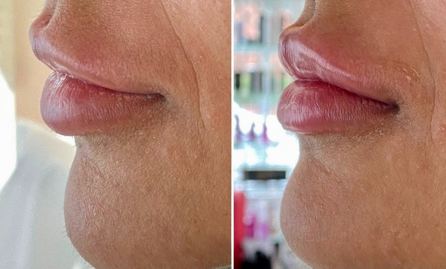 Image 2: Dermal Filler with Consultation