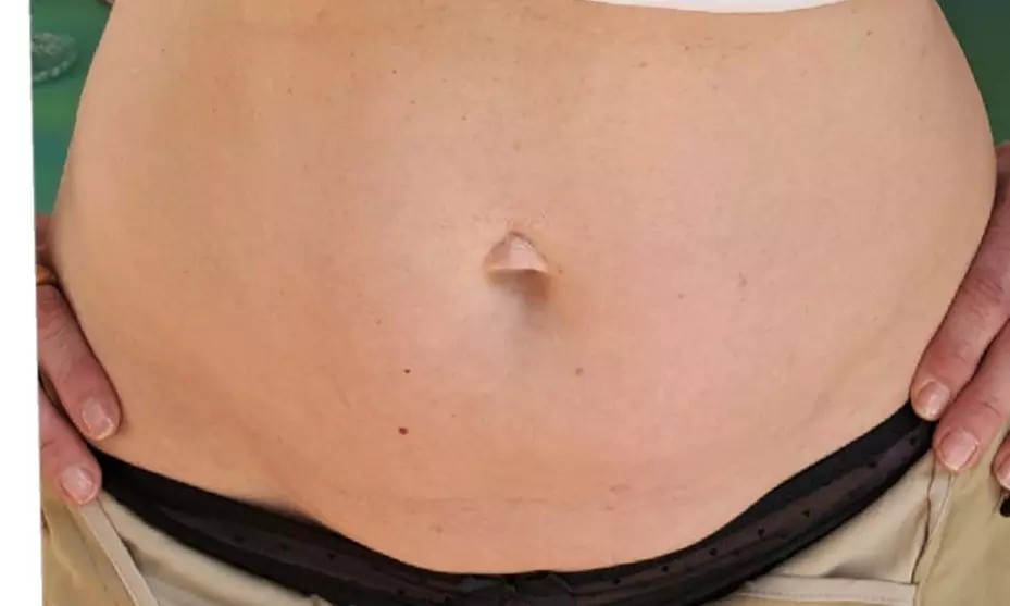 Afslanken & verstevigen met Hifu 12D - 22D behandeling naar keuze