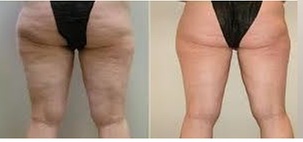 Cavitation