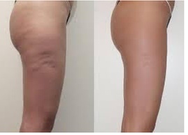 Cavitation