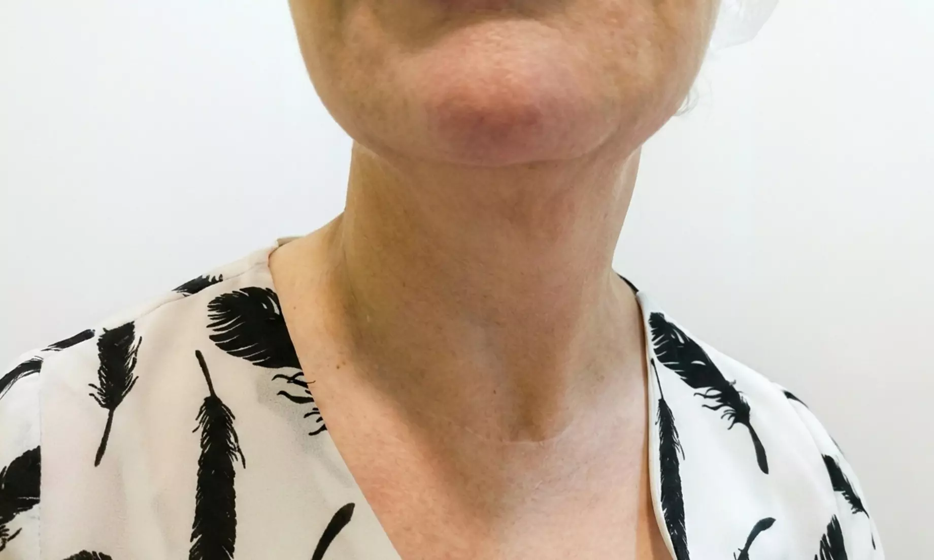 Tratamiento HIFU V10 MAX INDOLORO en rostro para 1 persona