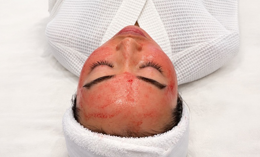 Image 2: Rejuvenate with PRP or Vampire Facials for a Radiant Glow