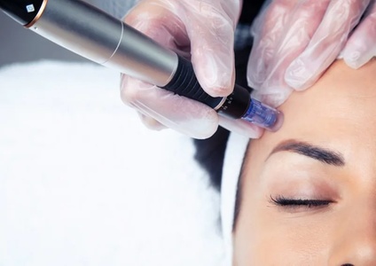 One Micro Channeling Treatment - Palma Aesthetics