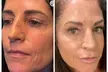 20 or 40 Units of Xeomin Treatments for Fine Lines at Starlite Aesthetics and Wellness (Up to 47% Off) - Image 3