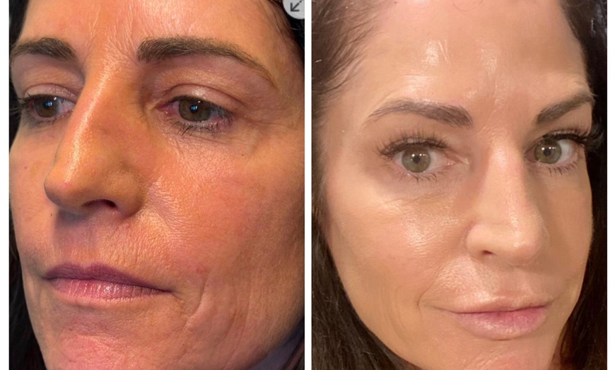 Image 3: Xeomin Treatments with 20 or 40 Units for Smoother Looking Skin