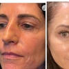 Image 3: Xeomin Treatments with 20 or 40 Units for Smoother Looking Skin