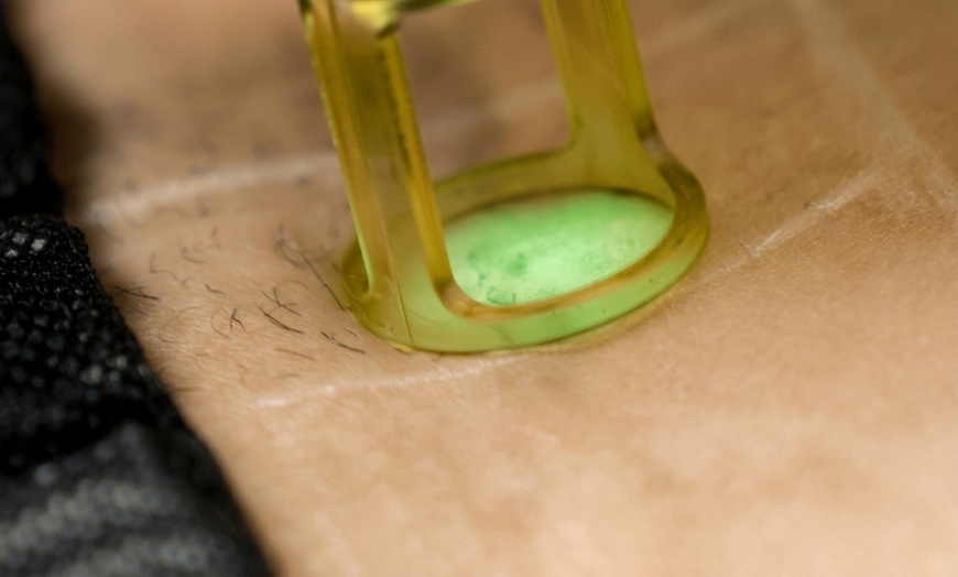 Image 2: Daily Confidence with Laser Hair Removal at SEV Laser Dublin