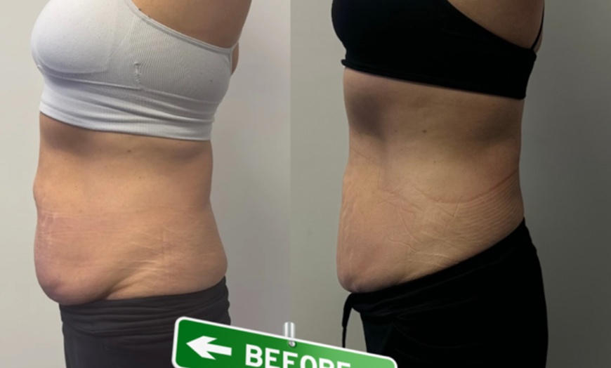 Image 6: Exxo Ice Facial & Body Contouring Sessions for a Refreshed Look