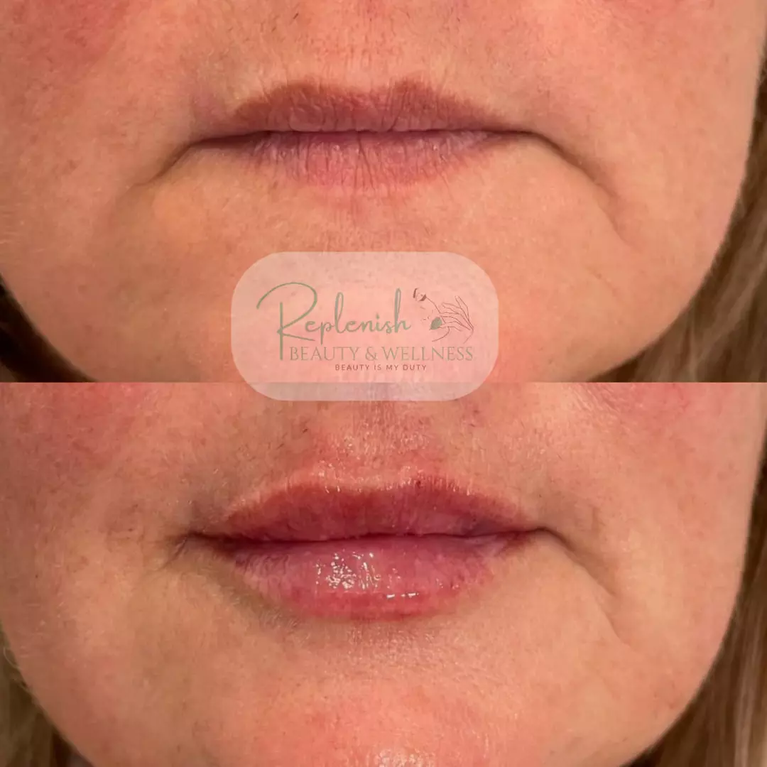 Glow Up: Lip flip, Daxxify OR Xeomin