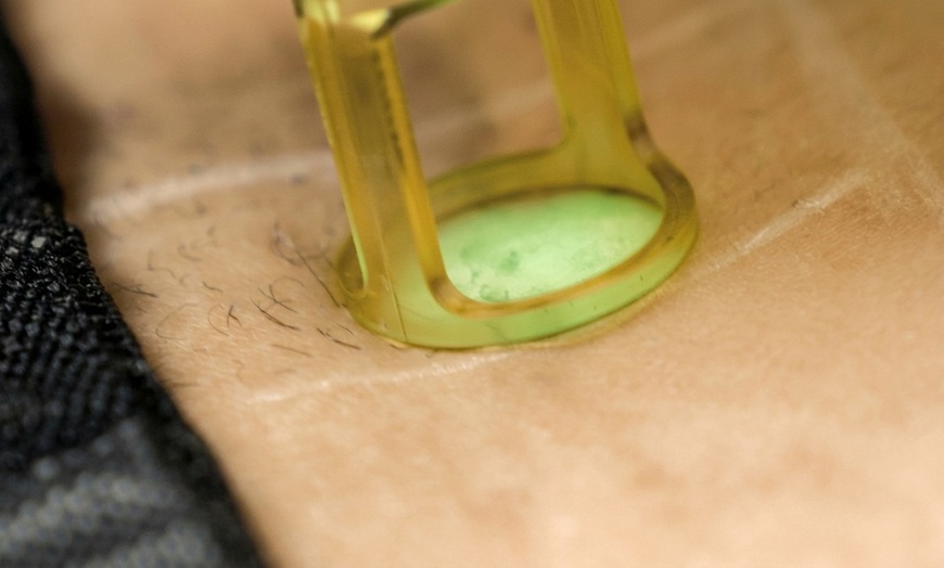 Image 3: SEV Laser: Expert Laser Hair Removal for All Skin Types in Yorba Linda