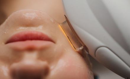 Two IPL photofacials - Lisa Meredith at Ensemble Salon
