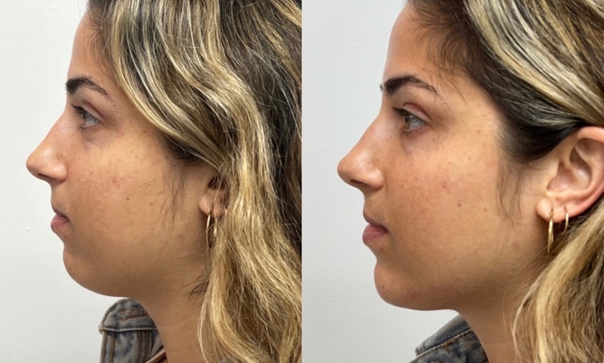 Image 7: Dermal Filler & Botulinum Toxin Treatments for Facial Rejuvenation
