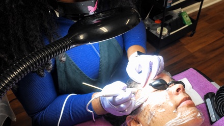 Single Skin Tag Treatment - Skin deep by Xena