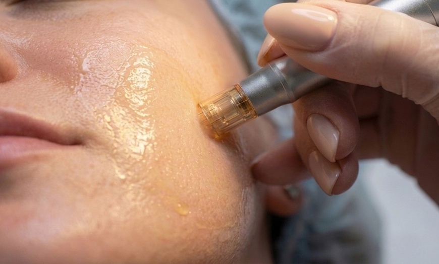 Image 3: Microneedling with Skin Analysis & Advanced Serum Therapy