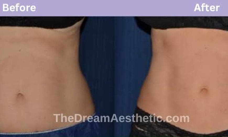 Image 6: Lymphatic Drainage Massage with Wood Therapy & Essential Oils