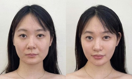 PRX Under Eye Treatment with Free Medical Grade Facial - Akoya Aesthetics & Wellness