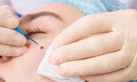 1 Skin Tag or Cherry Angioma Removal - Luvlookbeautyspa