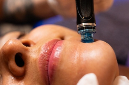 One Signature HydraFacial - ProMD Health Westminster