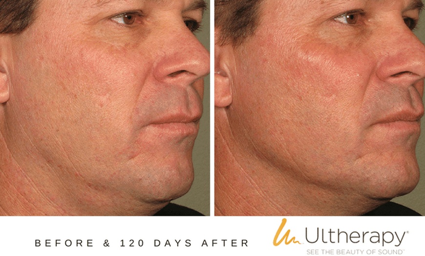 Image 5: Ultherapy: Non-Invasive Skin Lifting & Tightening for Face & Neck