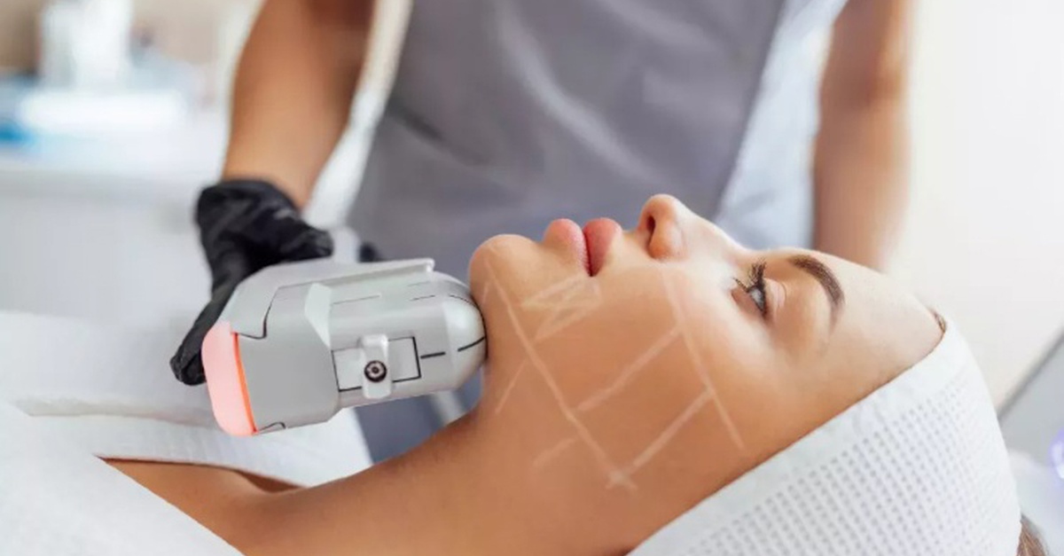 Tratamiento HIFU con radiofrecuencia facial en Madrid