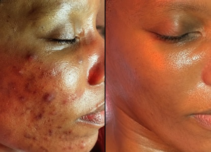 One 60-Minute Skin Analysis + Deep Pore Cleanse for Dark Spots & Uneven Skin Tone - Complexion Code Skin Clinic