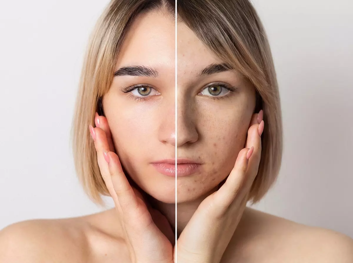 Microneedling, Aqua-Facial oder Gesichtsbehandlung für 1 Person