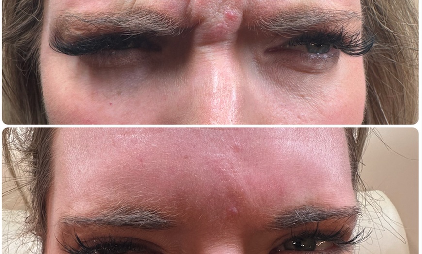 Image 4: 20-60 Units of Letybo for Frown Lines at Contour And Sculpt 