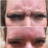 Image 4: 20-60 Units of Letybo for Frown Lines at Contour And Sculpt 