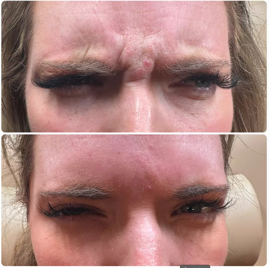 20-60 Units of Letybo for Frown Lines at Contour And Sculpt