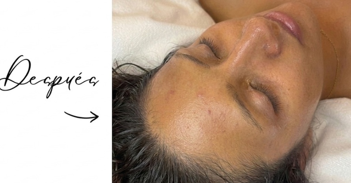 Tratamiento facial completo con limpieza e hidrodermoabrasión en Madrid