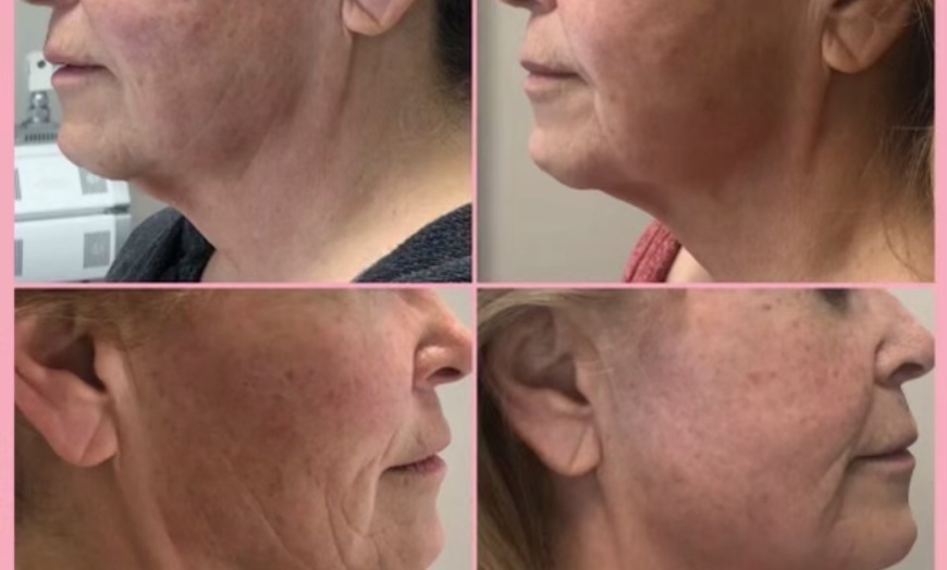 Image 6: Non-Invasive Face Lifts Using Radio Frequency Therma Lift