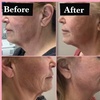 Image 6: Non-Invasive Face Lifts Using Radio Frequency Therma Lift