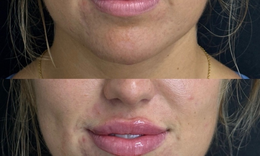 Image 10: Dermal Filler & Botulinum Toxin Treatments for Facial Rejuvenation