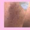 Image 1: Ditch the razor! Try the only FDA-Approved Permanent Electrolysis Hair Removal