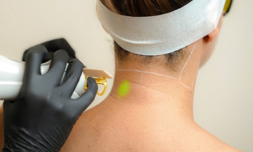 Image 2: Say Goodbye to Unwanted Hair! 6 Laser Sessions for Smooth, Silky Skin