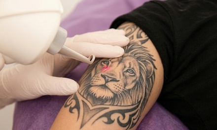 One Laser Tattoo Removal Session on a Small Area - Skin City 13 & Laser tattoo removal