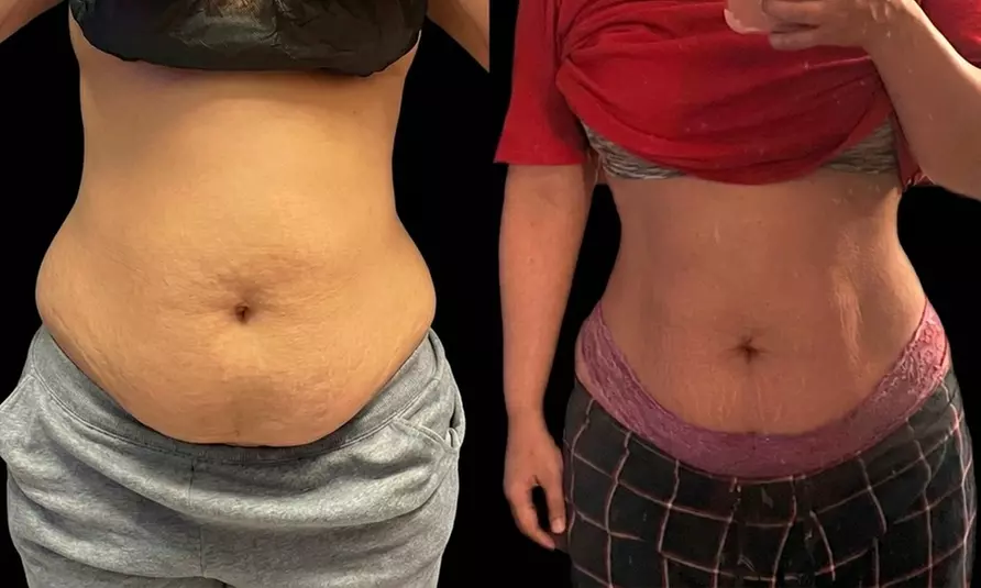 Revitalize with Fat Reduction with Skin Tightening Treatments