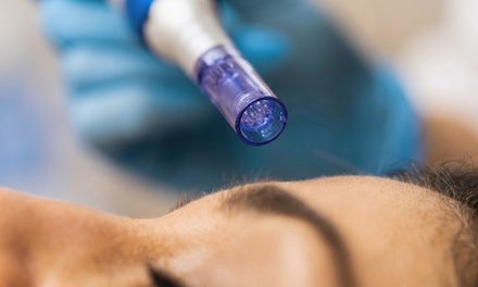 One Micro-Needling Treatment with Hyaluronic Acid - Bare Skin Beauty